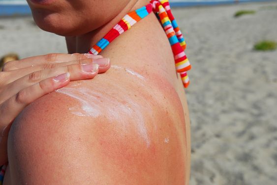 Effective Sunburn Treatments